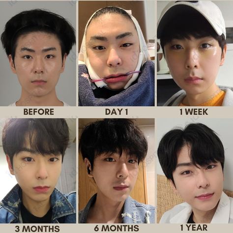 #idhospitalkorea #koreanplasticsurgery #plasticsurgery #plasticsurgerykorea #cosmeticsurgery #seoul #korea #IDtransformation #IDbeforeandafter #plasticsurgerybeforeandafter #beforeandafter #beforeandaftersurgery #besttransformation #cheekbonereduction #maleplasticsurgery #plasticsurgeryformen #vline #vlinesurgery #vshapeface #facialcontouring V Line Surgery, Plastic Surgery Korea, Korean Plastic Surgery, V Shape Face, Facial Contouring, Seoul Korea, Cosmetic Surgery, Aesthetic Makeup, Plastic Surgery