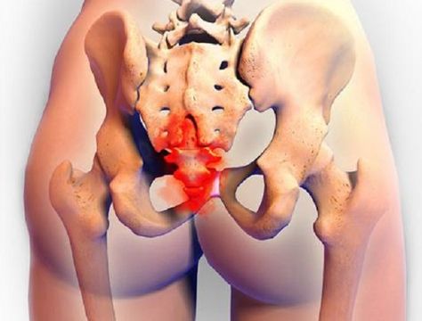 Coccyx Injury, Back Pain Relief Exercises, Tailbone Pain, Pelvic Floor Therapy, Severe Back Pain, Chronic Lower Back Pain, Pain Relief Remedies, Pelvic Floor Dysfunction, Piriformis Syndrome