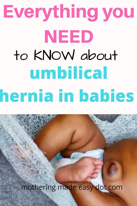 Some babies and infants develop umbilical hernia after the healing of umbilical cord. The consequences of having a hernia is often not serious except in cases where the intestine becomes obstructed. Low Birth Weight Babies, Baby Umbilical Cord, Colicky Baby, 1 Year Baby, Weight Baby, Newborn Baby Tips, Umbilical Cord, Baby Care Tips, Premature Baby