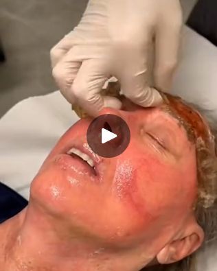 1.2M views · 14K reactions | Extreme facial change with phenol peeling! | Extreme facial change with phenol peeling! | By Beauty Studio | Facebook Phenol Peel, Acid Peel, Beauty Studio, Popular Videos, Facial, Baking, Beauty, Quick Saves