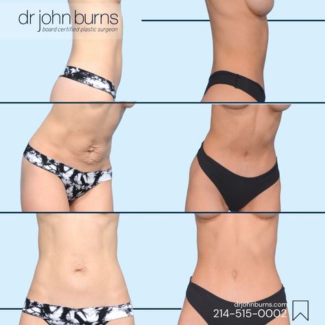 Tiny Tummy Tuck, Mini Tummy Tuck by Dr. John Burns, Dallas Plastic Surgeon Mini Tummy Tucks Before And After, Vaser Lipo, Lipo Before And After, Mommy Makeover Surgery, Muscle Separation, Strech Marks, Mummy Tummy, Diastasis Recti Exercises, Pregnancy Hormones