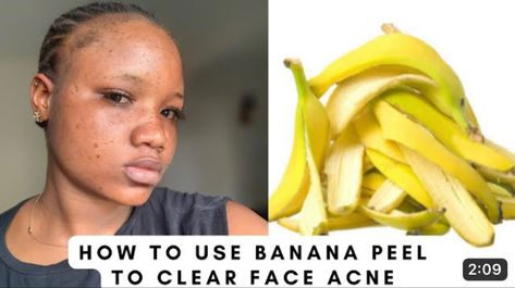 How to use banana to clear your acne’s, pimples Home Remedies For Face, Pimple Solution, Blind Pimple, Pimples Under The Skin, Acne Overnight, Pimples Remedies, Pimples On Face, Fresh Aloe Vera, Prevent Pimples