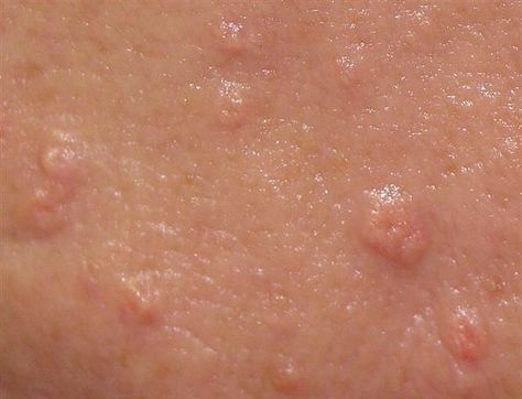 Red Bumps On Face, Ingrown Pimple, Skin Conditions Pictures, Skin Bumps On Face, Skin Rash On Face, Sebaceous Hyperplasia, Rash On Face, Skin Care Center, Pimples Under The Skin