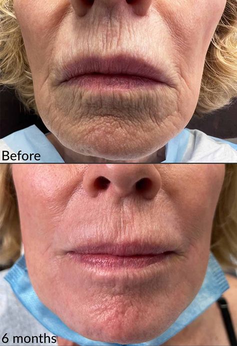 Vi Peel Before And After, Natural Chemical Peel At Home, Facial Chemical Peel Before And After, Chemical Peel Before And After, Chemical Peel Season, Chemical Peel Results, Phenol Peel, Full Body Chemical Peel, Best Chemical Peel