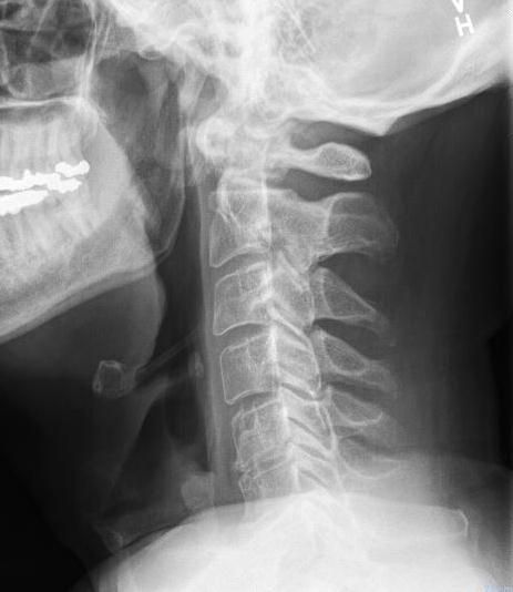 Broken Neck (Hangman's Fracture) - Morphopedics Severe Neck Pain, Cervical Disc, Neck Injury, Nuclear Medicine, Neck And Back Pain, Of Mice And Men, Whiplash, Radiology, Neck Pain