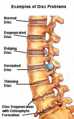 Lumbar Spondylosis & Prolapse Intervertebral Disc Homoeopathic Management Intervertebral Disc, Spinal Decompression, Bulging Disc, Spine Health, Spine Surgery, Human Skeleton, Sciatica Pain, Chiropractic Care, Chiropractic