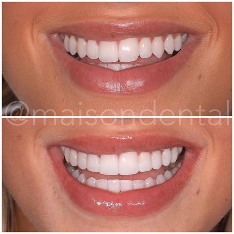 Edge Bonding Teeth, Composite Bonding Teeth, Teeth Composite, Composite Bonding, Pretty Teeth, Tooth Care, Veneers Teeth, Perfect Teeth, Smile Teeth