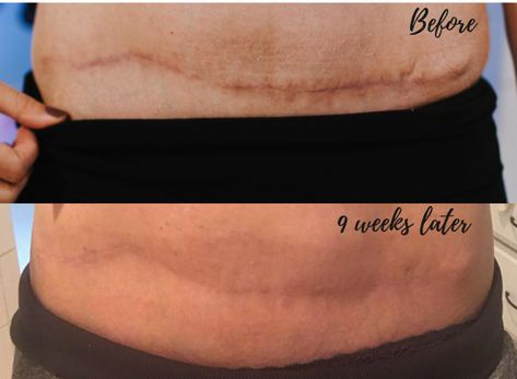 Diep Flap Before And After, C Section Scar Tissue Massage, Surgical Scar Remedies, Embrace Scar Therapy, Best Scar Cream After Surgery, Massaging C Section Scar, Thyroid Surgery Scar, After Abdominal Surgery, Lipo 360