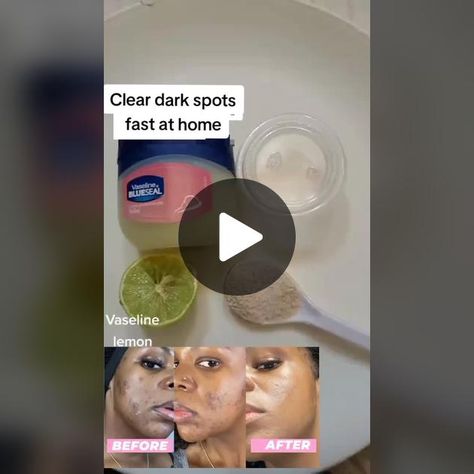 Clear dark spots on the face with just Vaseline,lemon and sugar #spots... | skin care | TikTok How To Clear Dark Spots On Face, Dark Spots Removal, Vaseline For Face, Clear Dark Spots, Smooth Face, Remove Dark Spots, Remove Acne, Black Spot, Vaseline