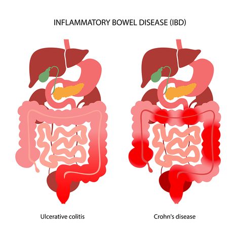 Inflammatory Bowel Disease (IBD) | Johns Hopkins Medicine Gut Inflammation, Abdominal Cramps, Inflammatory Bowel, Gi Tract, Medical Studies, Urinary Tract, Chronic Disease, Healthy Gut, Media Images