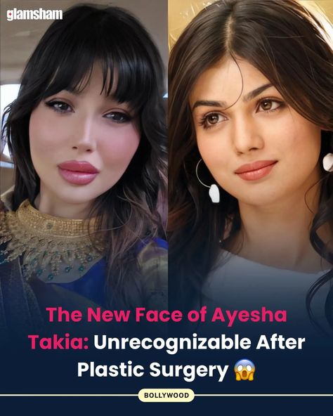 Bollywood actress Ayesha Takia left the internet shocked after her recent photos went viral online. The actress, who seems to have undergone multiple plastic surgeries, looked unrecognisable in the photos, and fans were left rather disappointed. "What has she done to her face? What was the need for all of this?" netizens asked. Ayesha quit films in 2011. #Glamsham #AyeshaTakia #Bollywood #News (AyeshaTakia, Bollywood, News) Bollywood News, New Face, Plastic Surgery, Bollywood Actress, Surgery, The Internet, Actresses, Internet, Film