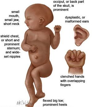 edwards syndrome - Google Search Medical Horror, Anatomy Diagrams, Edwards Syndrome, Sonography Student, Medical Sonography, Child Nursing, Diagnostic Medical Sonography, Neonatal Nurse, Nurse Rock