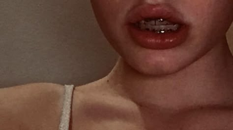 Brace Aesthetics, Teeth Aesthetic Braces, Bunny Teeth Aesthetic, Braces Aesthetic Girl, Lips With Braces, Crooked Teeth Aesthetic, Orthodontics Aesthetic, Brackets Aesthetic, Aesthetic Braces