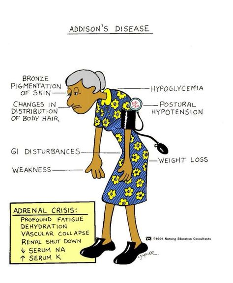 Addison's Disease Nursing, Addison's Disease, Nursing Board, Med Surg Nursing, Nursing Mnemonics, Nursing Care Plan, Nursing School Survival, Fundamentals Of Nursing, Nursing School Studying