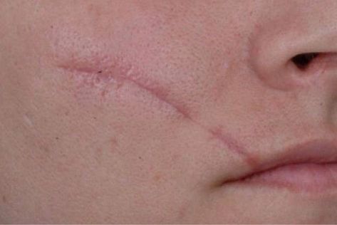 Get Rid Of Scars, Getting Rid Of Scars, Scar Remedies, Forehead Acne, Acne Scar Removal, Scar Removal, Instant Messaging, Acne Remedies, Skin Remedies