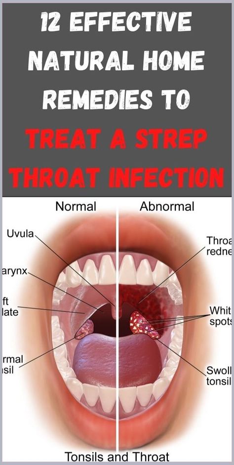 12 Effective Natural Home Remedies To Treat A Strep Throat Infection Remedy For Headache, Strep Throat Symptoms, Strep Throat Remedies, Holistic Healing Quotes, Daily Routine For Women, Artery Cleanse, Home Remedy For Headache, Throat Remedies, Throat Infection