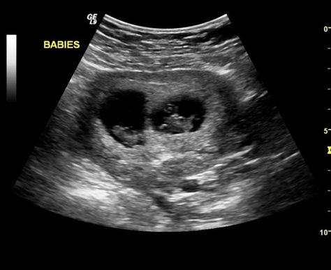 Twin Ultrasound Pictures: Stacey's Twins: Eight Weeks Twin Ultrasound Pictures, Ultrasound Pictures 8 Weeks, Early Signs Of Twins, Twin Ultrasound, 16 Weeks Pregnant Ultrasound, Twins Ultrasound, Baby Ultrasound Pictures, 2 Week Wait, Am I Pregnant