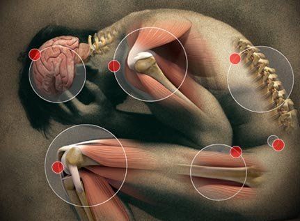 What does a Rheumatoid Arthritis flare feel like? Food That Causes Inflammation, Guillain Barre, Fibro Warrior, Stem Cell Therapy, Inflammatory Foods, Chronic Inflammation, Chronic Fatigue, Muscle Pain, Medical Prescription