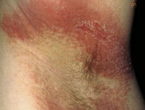 Intertrigo (Rash in body folds): Causes, Images, and More — DermNet Groin Rash, Allergy Rash, Armpit Rash, Rash On Neck, Warts Remedy, Signs Of Inflammation, Red Rash, Sunburn Remedies, Itchy Rash