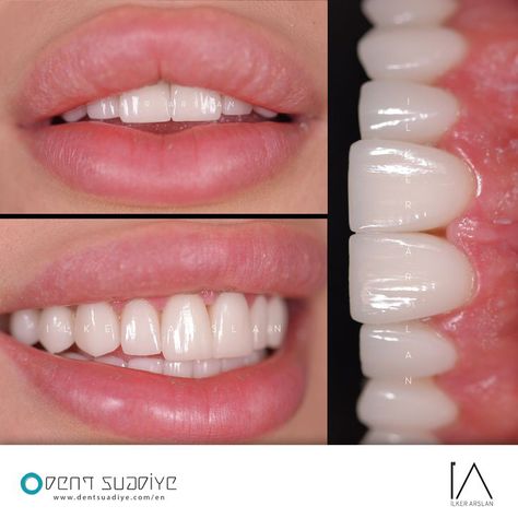 Teeth Makeover, Perfect Smile Teeth, Teeth Aesthetic, Pretty Teeth, Botox Lips, Veneers Teeth, Aesthetic Dentistry, Beautiful Teeth, Straight Teeth