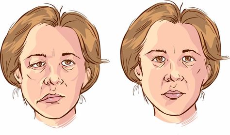 Bell’s Palsy, Muscles Of The Face, Bells Palsy, Facial Nerve, Short Quiz, Muscle Weakness, Medical Tourism, Facial Muscles, Alternative Treatments