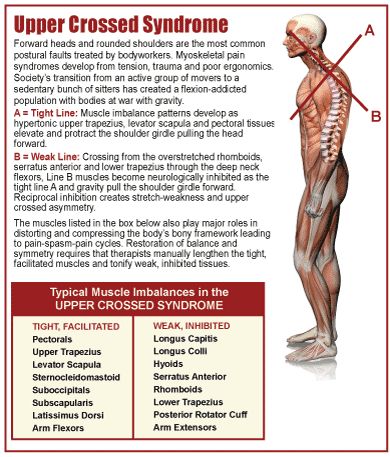 Weakness of the deep cervical flexors ventrally crosses with weakness of the middle and lower trapezius. Description from sgphysio.wordpress.com. I searched for this on bing.com/images Prime Movers Muscles, Lumbar Anatomy, Upper Cross Syndrome, Punkty Spustowe, Psoas Release, Posture Exercises, Muscle Imbalance, Muscle Anatomy, Sports Massage