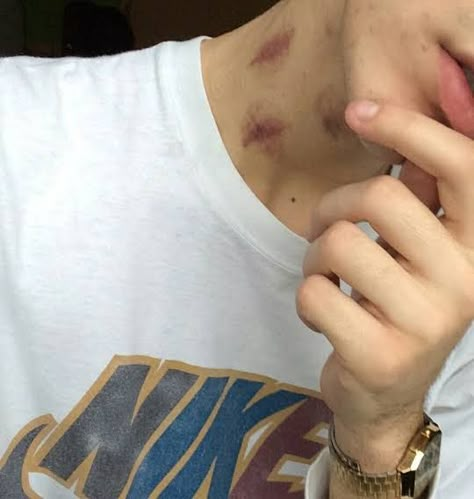 Hickey On Boy, Hickies Neck Aesthetic Guy, Hicks On Neck, Dean Di Laurentis, Hickies Neck, Vintage Disney Art, Kiss Mark, Inappropriate Thoughts, Love Bites