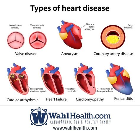 There are many types of heart diseases that can be avoided. Come in for an appointment today! Check out our website to learn more: www.WahlHealth.com Types Of Heart, Diet Schedule, Cardiac Nursing, Coronary Arteries, Heart Conditions, Nursing Study, Medical Knowledge, Cardiovascular Disease, Heart Health