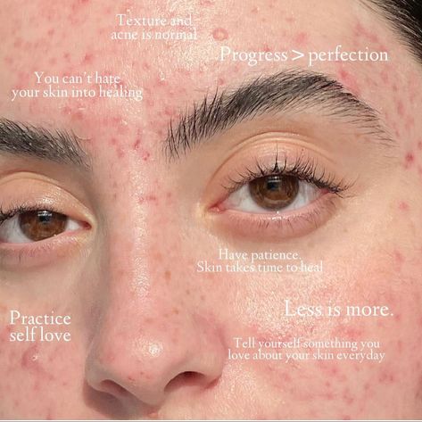 Quotes About Acne Positivity, Acne Self Love, Embracing Acne, Acne Confidence, Acne Pretty, Acne Positivity, Skin Positivity, Bad Acne, Body Positive Quotes