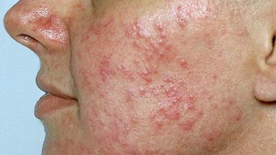 Rosacea Causes and Triggers Hives On Face, Skin Diseases Pictures, Skin Disease Pictures, Remove Skin Tags Naturally, Systemic Inflammation, Mecca Kaaba, Home Remedies For Skin, Skin Moles, Sweat Gland