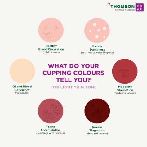 What Do Your Cupping Colours Tell You? | Thomson Chinese Medicine Lavender Health Benefits, Hijama Points, Cupping Points, Qi Stagnation, Wet Cupping, Traditional Chinese Medicine Acupuncture, Chinese Cupping, Coffee Cupping, Hijama Cupping