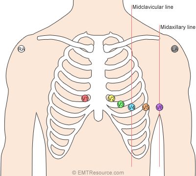 12-lead-ecg-placement 12 Lead Ekg Placement, Ecg Placement, Ekg Placement, Lead Placement, Cardiac Dysrhythmias, Ekg Leads, Ekg Tattoo, Emt Study, Ekg Interpretation