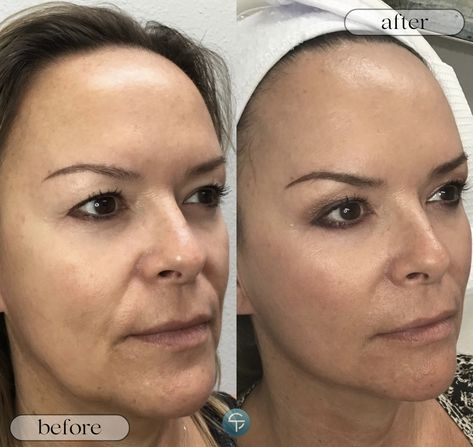 ✨ Witness the magic of Fotona4D Lift! ✨  Non-invasive, no downtime, just stunning results! Fotona 4D offers a non-surgical facelift alternative that delivers natural-looking, long-lasting results. 💫 Face Lift Aesthetic, Thread Lift Face Before And After, Botox Tips, Laser Face, Hifu Face, Neck Lift Surgery, Chiseled Jawline, Non Surgical Facelift, Face Lift Surgery