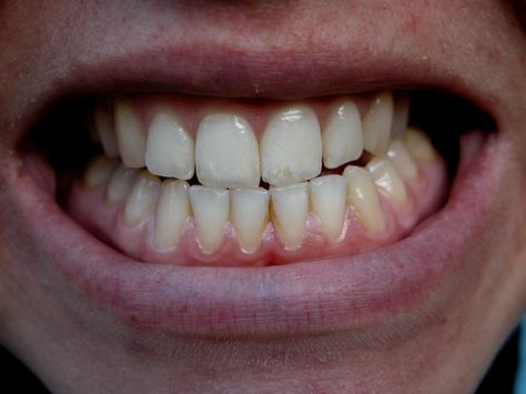 The force from #grinding your #teeth may contribute to #gum #recession even if your oral hygiene is excellent. http://goo.gl/aWwYmJ White Teeth Overnight, Make Teeth Whiter, Teeth Diseases, Muscles Of The Neck, Natural Mouthwash, Jaw Clenching, Get Whiter Teeth, Teeth Grinding, Tooth Enamel