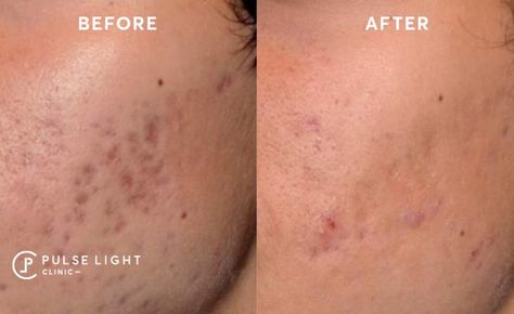 Laser Acne Scar Removal, Acne Laser, Acne Scar, Acne Scar Removal, Skin Specialist, Board Inspiration, Scar Removal, Skin Pores, Mood Board Inspiration