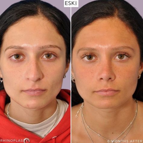 Look at the result on this patient 6 months post #primaryrhinoplasty and #septoplasty Dr. Kwak's work is done with utmost precision which is noted in the subtle but impactful lift of the nose tip. 

#drkwak #dredwardskwak #eskmd #plasticsurgeon #nycplasticsurgeon #plasticsurgeons #rhinoplasty #rhinoplastybeforeandafter #rhinoplastyspecialist #rhinoplastyresults #ethnicrhinoplasty #noseaugmentation #nosejob #nosejobs #nosejobbeforeandafter #nosejobdiary #nosejobcheck Ethnic Rhinoplasty, Nose Tip, Rhinoplasty Before And After, Nose Job, The Nose, Plastic Surgeon, 6 Months, Look At