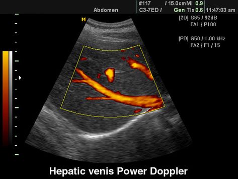 Vessels: Hepatic veins, power doppler. Echogramm №96 was received by the scanner SonoAce-8000. Edelman Ultrasound Physics, Vascular Ultrasound Anatomy, Transcranial Doppler Ultrasound, Transducers Ultrasound, Medical Sonography, Vascular Ultrasound, Diagnostic Medical Sonography, Ultrasound, Medical