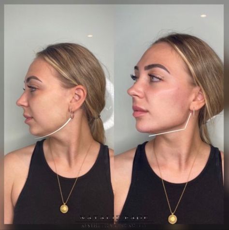 Best Jawline Female, Jawline Female, Jawline Transformation, Snatched Jawline, Recreate Photos, Good Jawline, Photo Recreation, Healthy Tips, Vision Board