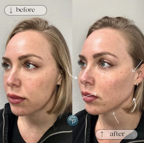 Results immediately after Sculptra! ✨ Sculptra is an FDA-approved injectable made of poly-L-lactic acid (PLLA) used to restore facial volume and treat wrinkles by stimulating collagen production that can last up to two years!  https://skintellectonline.com/injectables/ Columella Surgery, Collagen Threads, Cosmelan Peel Before And After, How To Rebuild Collagen In The Face, Laser Resurfacing Alastin Skincare®, Beauty Procedures, Collagen Production, Lactic Acid, Fda Approved