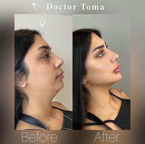 Double Chin Surgery Before And After, Jaw Line Fillers Before And After, Jawline Before And After, Jaw Filler Before And After, Face Fillers Before And After, Kybella Before And After, Under Eye Filler Before And After, Jawline Fillers Before And After, Facial Balancing Filler