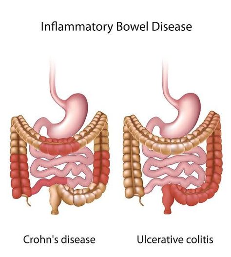 INFLAMMATORY BOWEL DISEASE comprises mainly of two diseases, th CROHN'S disease which mainly influences the ileo-ceacal region, whereas the other disease, i.e, ULCERATIVE COLITIS affects the colo-rectal region mostly Chronic Pain Awareness, Inflammatory Bowel, Chronic Pain, Stools, Disease, Real Life, Health, Quick Saves