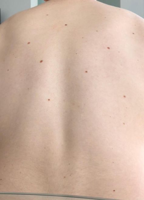 Has anyone ever had multiple small moles removed? Looking to have some done this summer and curious if anyone has advice. Mole Meaning, Moles On Face, Red Moles, Turmeric Health, Blood Sugar Diet, Midsize Style, Face Aesthetic, Beauty Mark, Natural Pain Relief