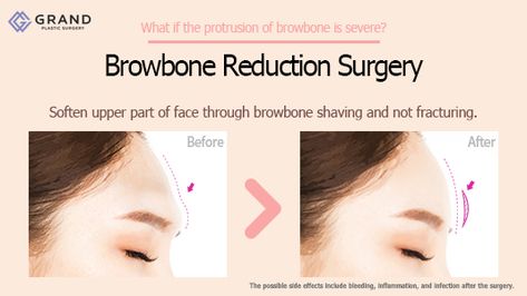 Brow Bone Reduction, Forehead Surgery, Reduction Surgery, Cosmetic Surgery, Free Consultation, Plastic Surgery, Beauty Tips, Shaving, Surgery