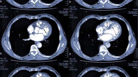 Heart Scan, Arm Veins, Heart Arteries, Heart Structure, Cat Scan, Radiation Exposure, Congenital Heart, Mri Scan, Heart Pump