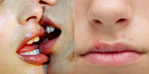 5 Diseases And Infections You Can Get From Kissing Kissing Disease, Swollen Lips, Sore Lips, Body Fluid, Body Ache, Cold Sore, Lip Hair, Perfect Lips, Blood Vessels