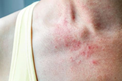 Slideshow: Signs of Immune System Problems Skin Rashes Pictures Types Of, Post Gallbladder Surgery Diet, Skin Rashes Pictures, Skin Disease Pictures, Common Skin Rashes, Closed Comedones, Diseases Pictures, Skin Blackheads, Red Rash