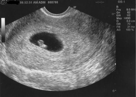 4 Weeks Pregnant Ultrasound, 6 Weeks Pregnant Ultrasound, Fake Ultrasound, 16 Weeks Pregnant Ultrasound, 3 Weeks Pregnant, Baby Ultrasound Pictures, 4 Weeks Pregnant, 6 Weeks Pregnant, Fake Pregnancy