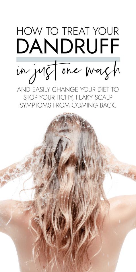 Get rid of dandruff overnight with just one wash stop the itchy, flaky scalp symptoms from coming back with simple changes to your diet. Scalp Mask For Dandruff, Itchy Scalp Remedy, Severe Dandruff, Treat Dandruff, Natural Dandruff Remedy, Itchy Flaky Scalp, Dry Flaky Scalp, Rid Of Dandruff, Oily Skin Remedy