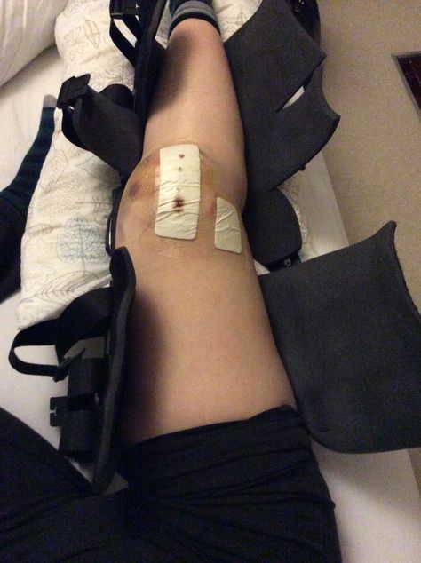 Trochleoplasty 4 days post op knee surgery #knees #postop #kneesurgery #trochleoplasty Acl Aesthetic, Dislocated Knee, Injury Aesthetic, Broken Knee, Candle Photography Dark, Surgery Aesthetic, Acl Recovery, Fake Injury, Basic Aesthetic