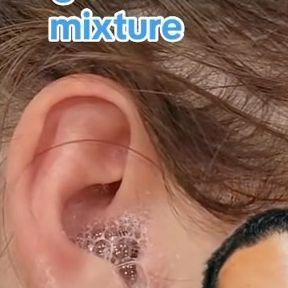 Dr. Sina Joorabchi on Instagram: "Peroxide in the ears for earwax . . . . . #earwax #earinfections #ears #health #reels #instagramreels" Squeezing Blackheads, Fluid In Ears, Ear Cleaning, Ear Wax, September 16, Beauty Skin Care Routine, Natural Home Remedies, Cleaning Solutions, Blackheads